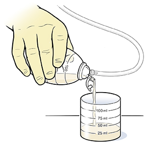 Gloved hand pouring fluid from drainage bulb into measuring flask.